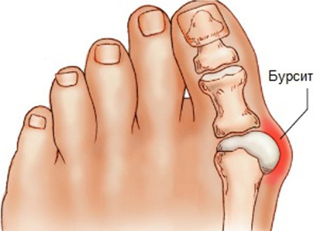 Воспаление большого пальца ноги и его лечение