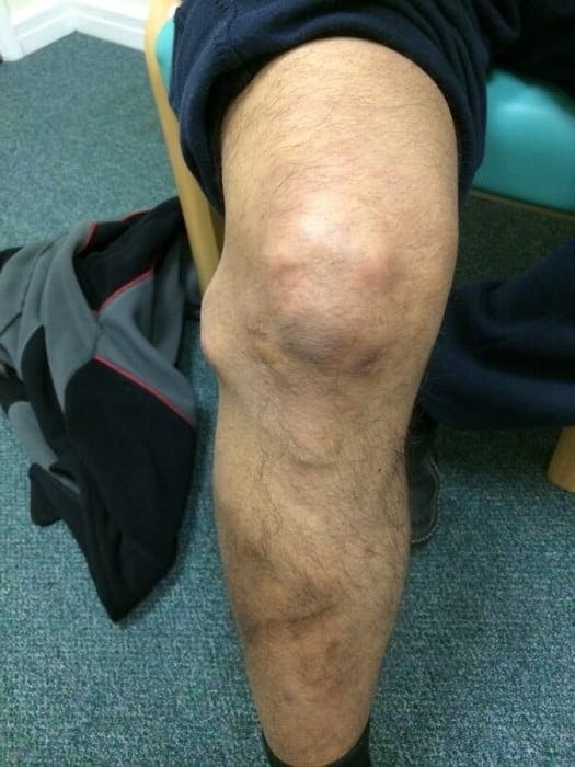 Гигрома коленного сустава фото причины и лечение