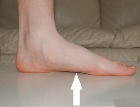 Гипермобильность коленного сустава лечение