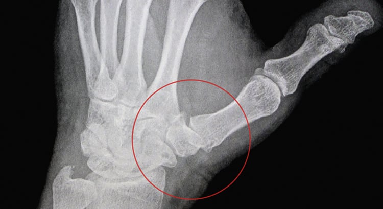 Лечение артроза большого пальца правой руки