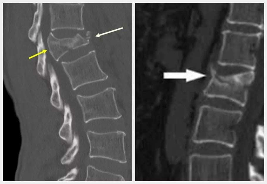 Лечение остеопороза пояснично крестцового отдела позвоночника thumbnail