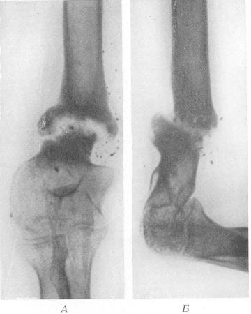 Переломы ног ложный сустав