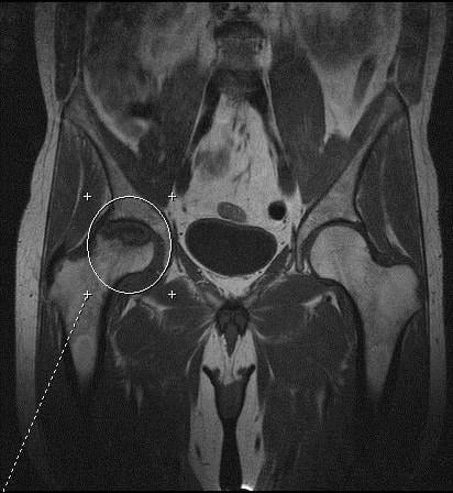 МРТ тазобедренного сустава что показывает,как делают мрт бедра