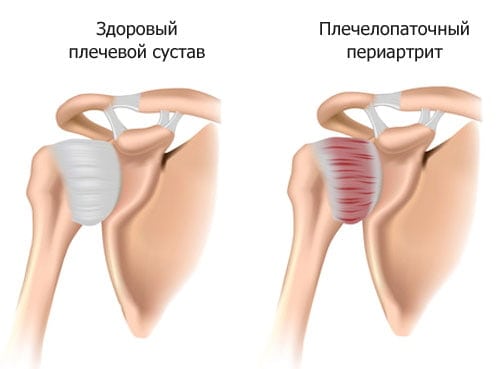 Воспаление плечевого сустава симптомы лечение