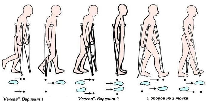 Корригирующая остеотомия коленного сустава фото