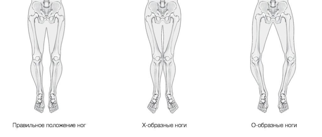 Корригирующая остеотомия коленного сустава фото