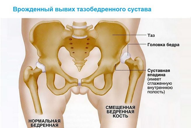 Изображение - Как лечить врожденный вывих тазобедренного сустава Bolyat-tazobedrennye-sustavy-prichiny-i-lechenie