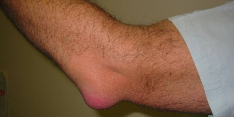 Лечение воспаления суставов локтевого сустава thumbnail