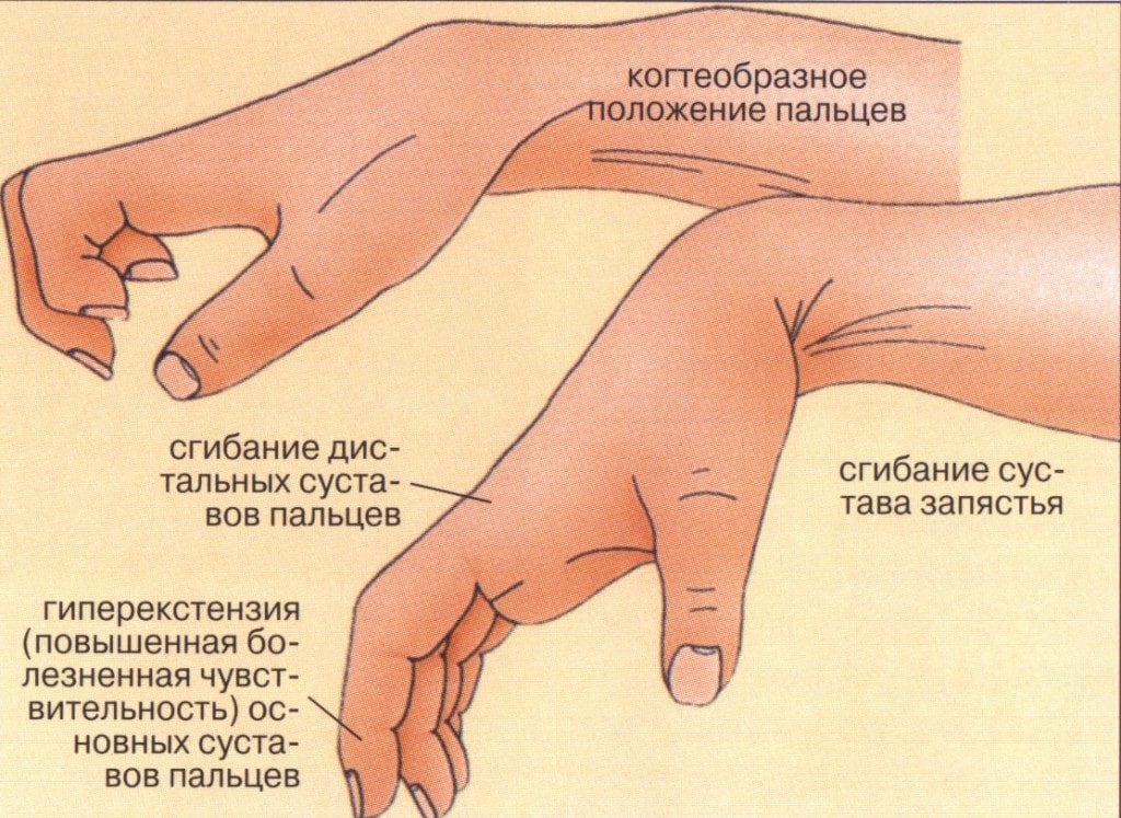 Лечение вывихов суставов рук