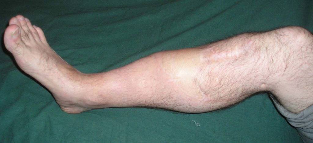 Ложные суставы голени после лечения перелома