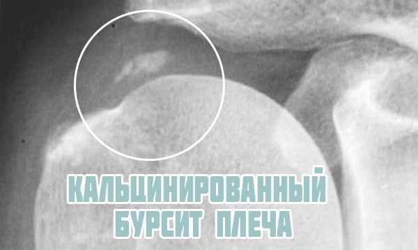 Изображение - Воспаление сустава плеча kalcinirovannyj-bursit-plecha