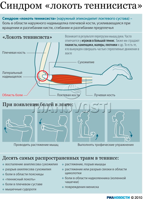 Что делать если болит рука. Локоть теннисиста эпикондилит. Упражнения для локтевого сустава локоть теннисиста. Лекарство при эпикондилите локтевого сустава. Внутренний эпикондилит локтевого сустава.