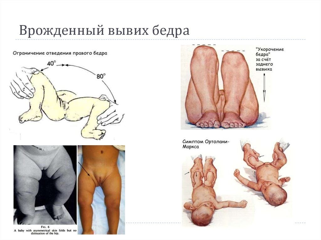 Изображение - Как лечить врожденный вывих тазобедренного сустава slide-53-1024x767