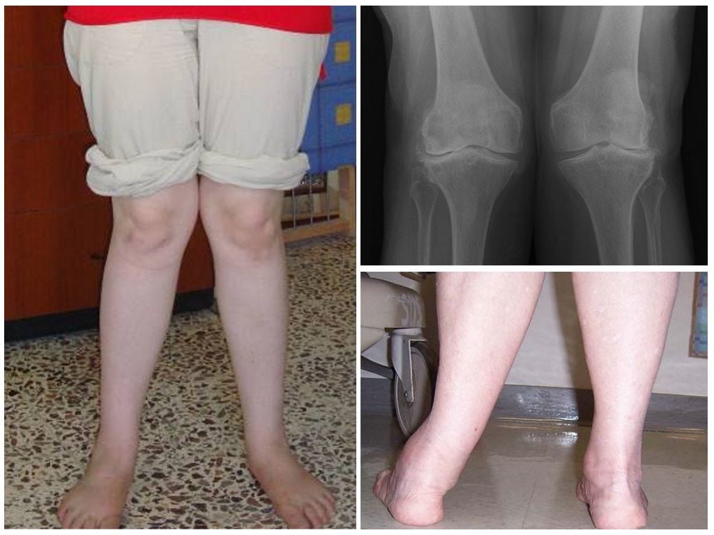 Вальгусная деформация коленных суставов как вылечить