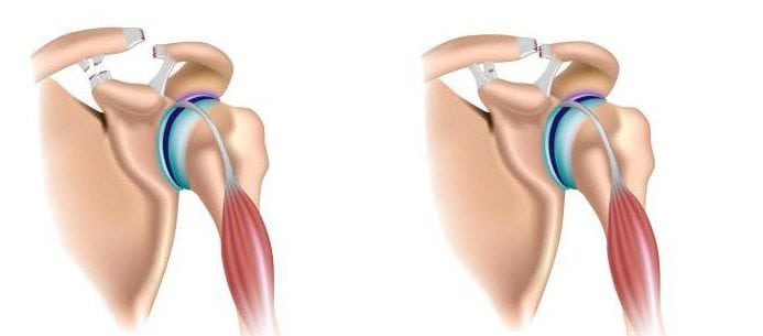 Разрыв связок плечевого сустава: лечение, симптомы