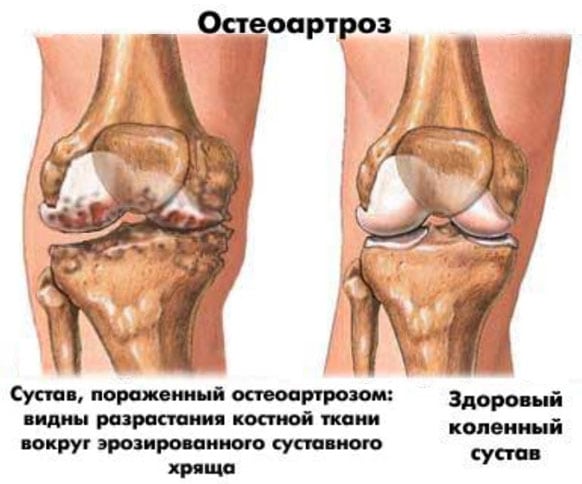Болят мышцы над коленями после тренировки
