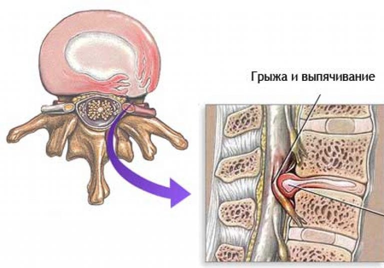 Обезболить при позвоночной грыже