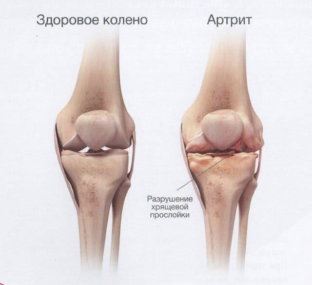 Чем отличается артроз от артрита коленного сустава симптомы и лечение