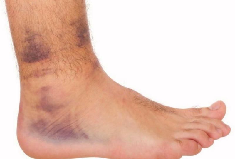 Изображение - Как лечить ушиб голеностопного сустава bruises