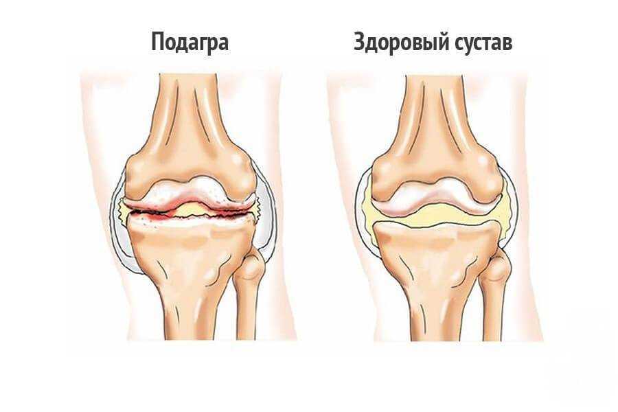 Могут ли болеть колени при подагре