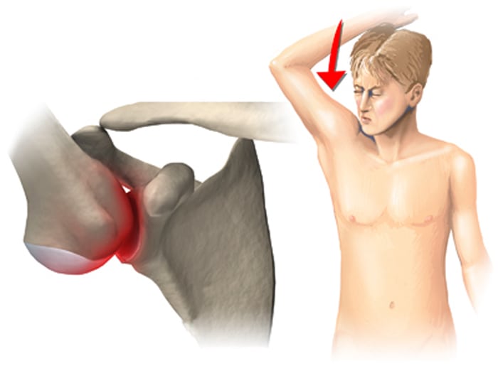 Синдром импичмента плечевого сустава лечение
