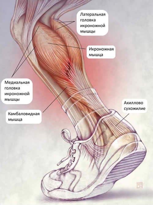 Растяжение икроножной мышцы правая нога