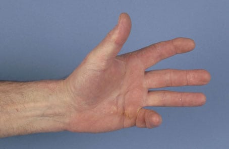 Серонегативный ревматоидный артрит кистей рук thumbnail