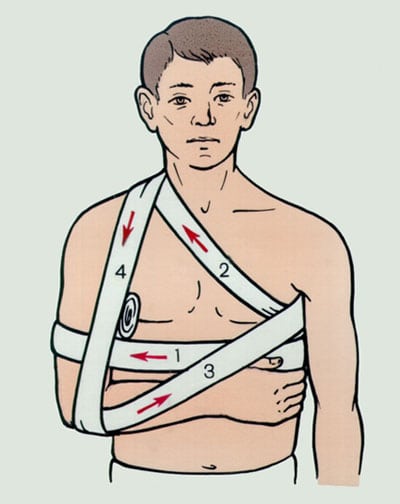 Изображение - Вылетает плечевой сустав что делать как лечить 287-5