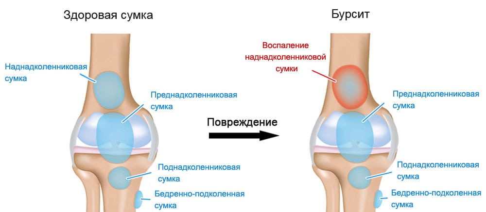 Травмы колена нет отека боль
