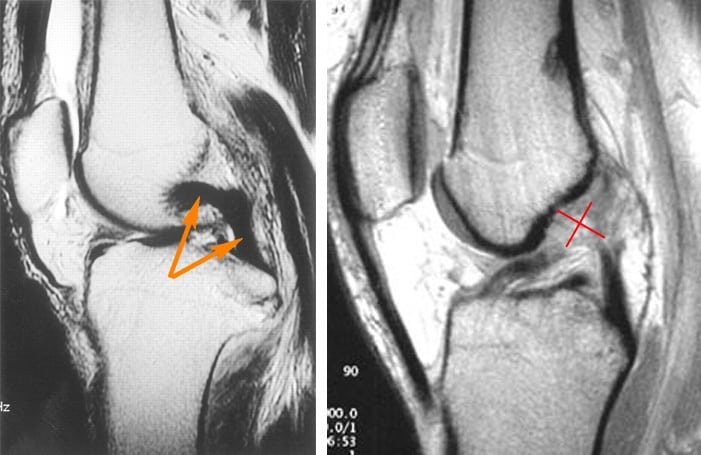 Лечение разрыва задней крестообразной связки коленного сустава thumbnail