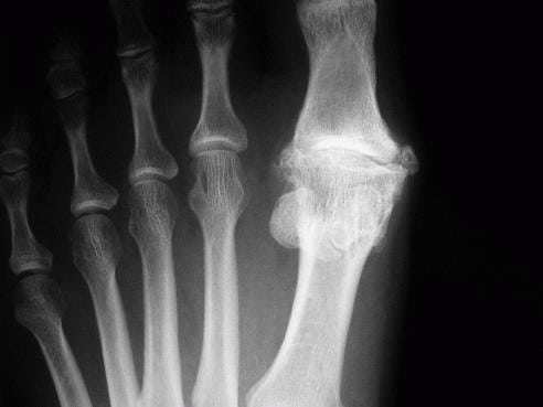 Воспаление большого пальца ноги и его лечение thumbnail