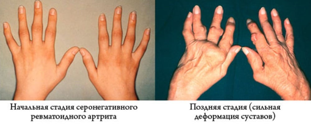 Ревматоидный серонегативный артрит симптомы лечение
