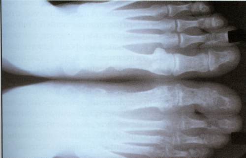 Ревматоидный артрит после хламидиоза