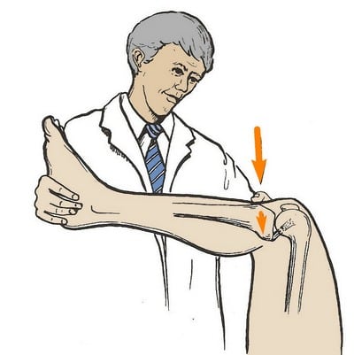 Повреждение задней связки коленного сустава лечение