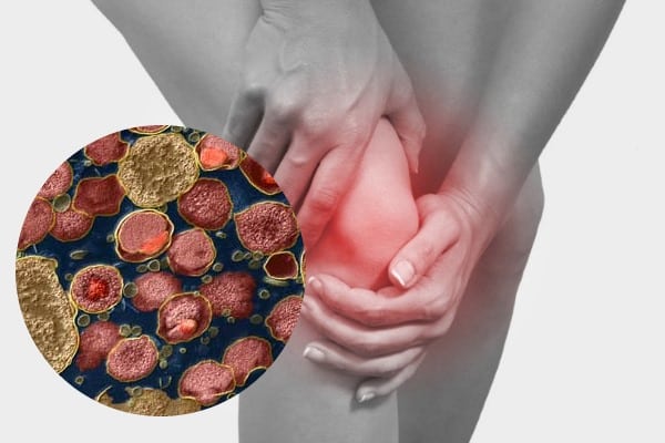Хламидийный артрит коленного сустава лечение