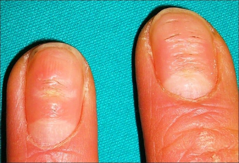 Ревматоидный артрит и хламидийная инфекция