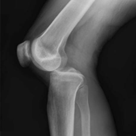 Вывих коленного сустава лечение в домашних условиях thumbnail