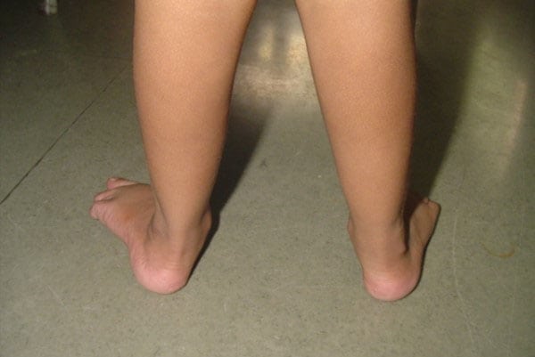 Искривление ног у ребенка 1 год комаровский