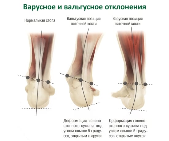 Воспаление сустава большого пальца ноги как лечить