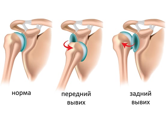 Изображение - Вылетает плечевой сустав лечение vyvih_plechevogo_sustava_simptomy