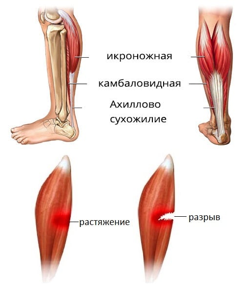 Растяжение мышц на ноге первая и