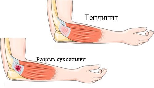Изображение - Болит локтевой сустав после тренировки Izobrazheniye-tendinita-na-ryke