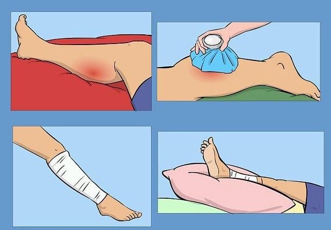 Лечение растяжение мышцы ноги