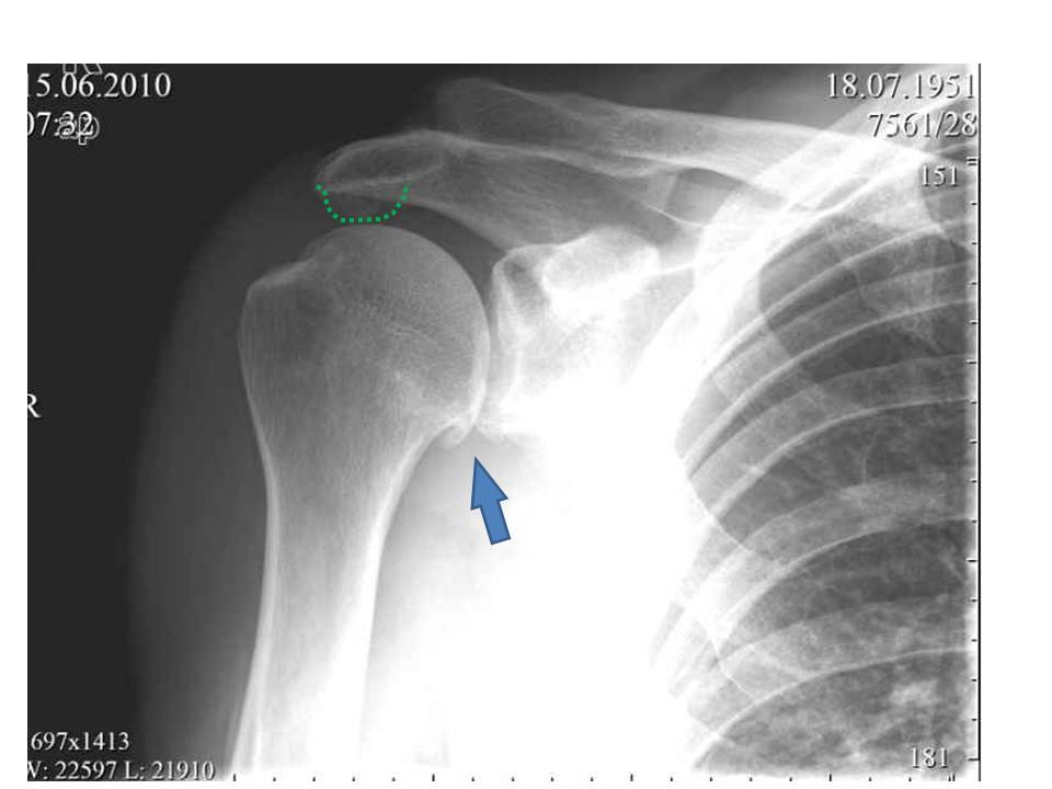 Что такое импиджмент синдром плечевого сустава thumbnail