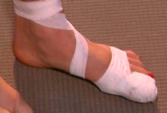Что такое лангетка на ногу перелом