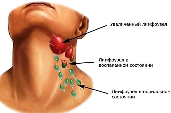 Боль на шее в области лимфоузлов