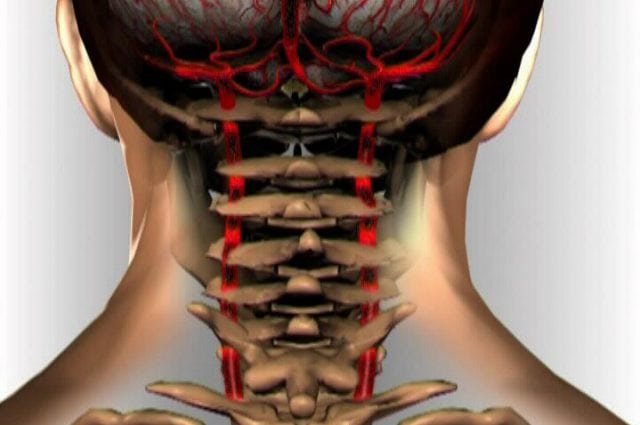 Что такое остеохондроз шейного отдела позвоночника и чем опасен