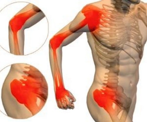Изображение - Воспаление суставов после ангины arthralgia