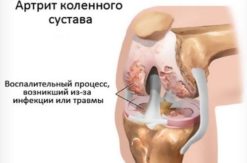 Артроз или артрит коленного сустава как отличить