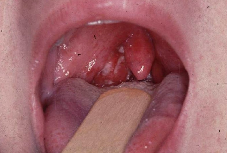 Изображение - Какие последствия после ангины на суставы enlarged-tonsils-pictures-4